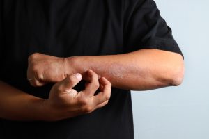 a-comprehensive-guide-to-atopic-dermatitis