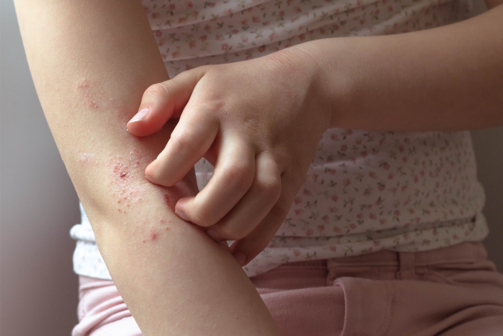 pediatric-psoriasis-vs-eczema