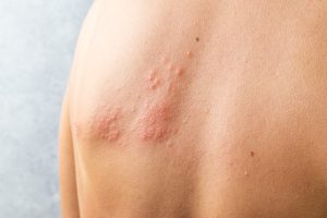 the-ultimate-guide-to-help-you-understand-and-treat-urticaria-hives