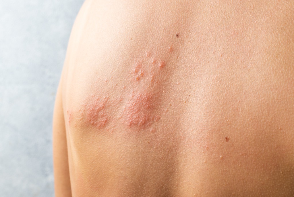the-ultimate-guide-to-help-you-understand-and-treat-urticaria-hives