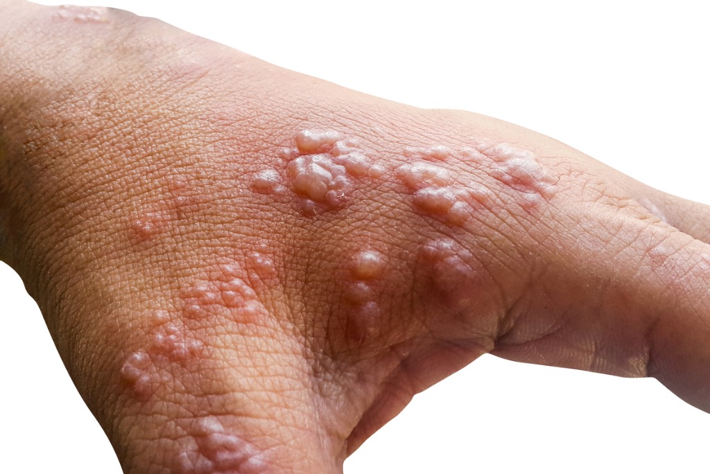 bullous-pemphigoid-causes-symptoms-and-potential-treatments