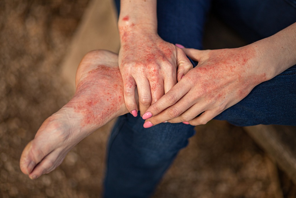 exploring-the-psoriasis-diet-connection