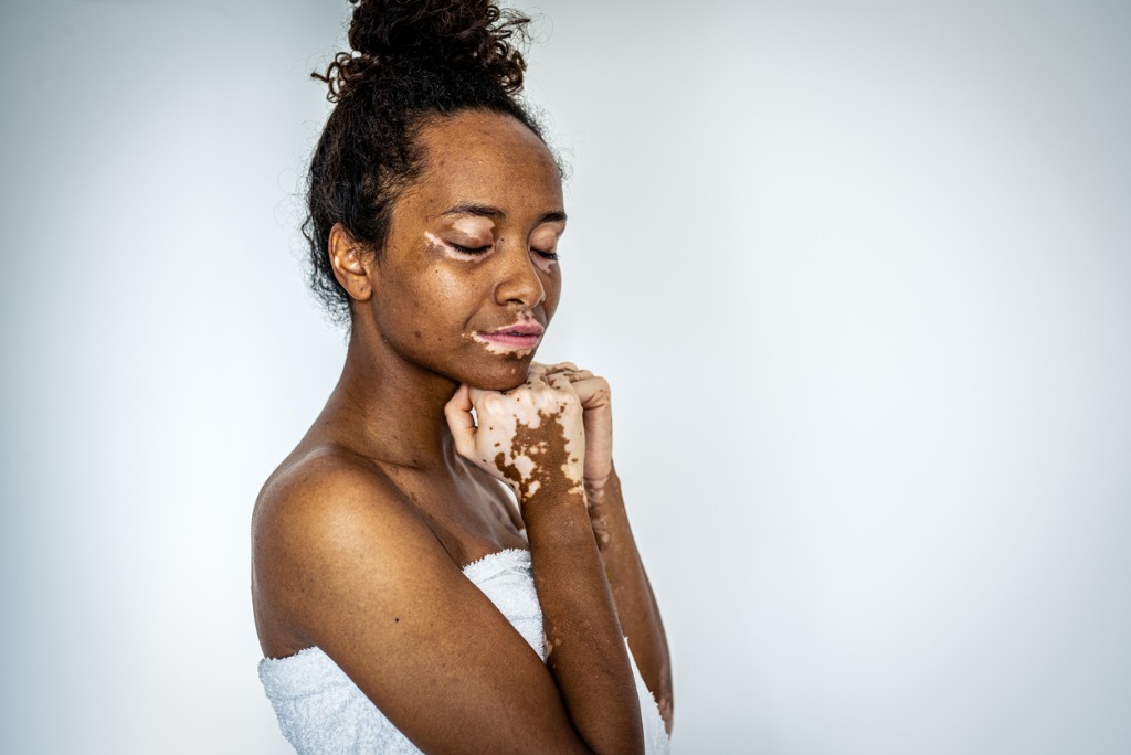 the-role-of-genetics-is-vitiligo-hereditary