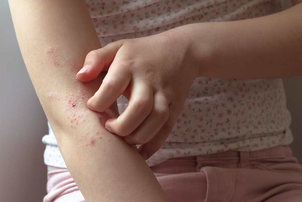 quick-guide-to-pediatric-plaque-psoriasis