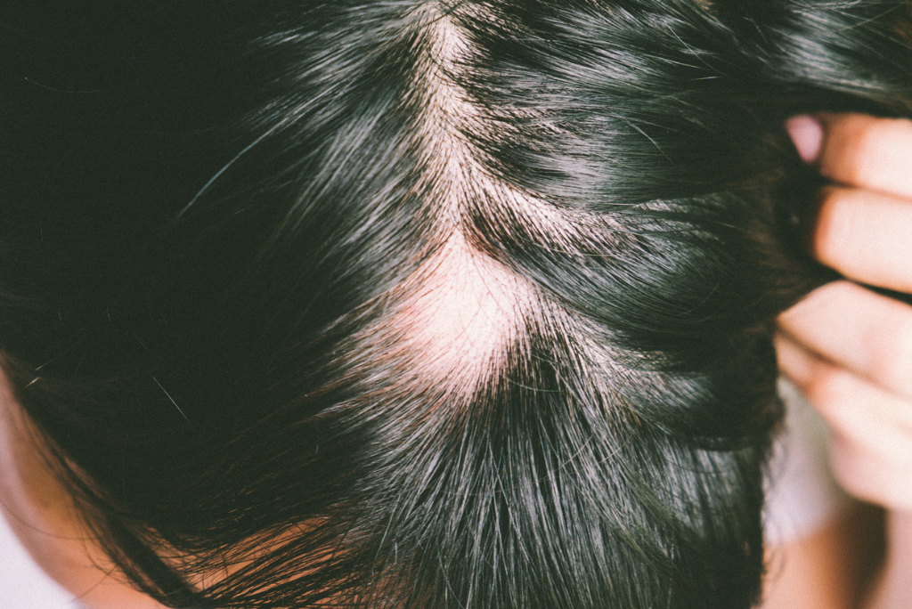 alopecia-areata-types-symptoms-and-triggers