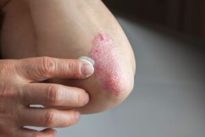 the-evolution-of-plaque-psoriasis-treatments