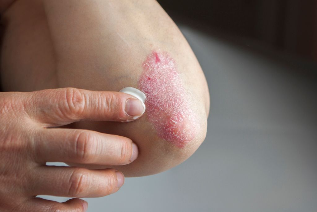 the-evolution-of-plaque-psoriasis-treatments