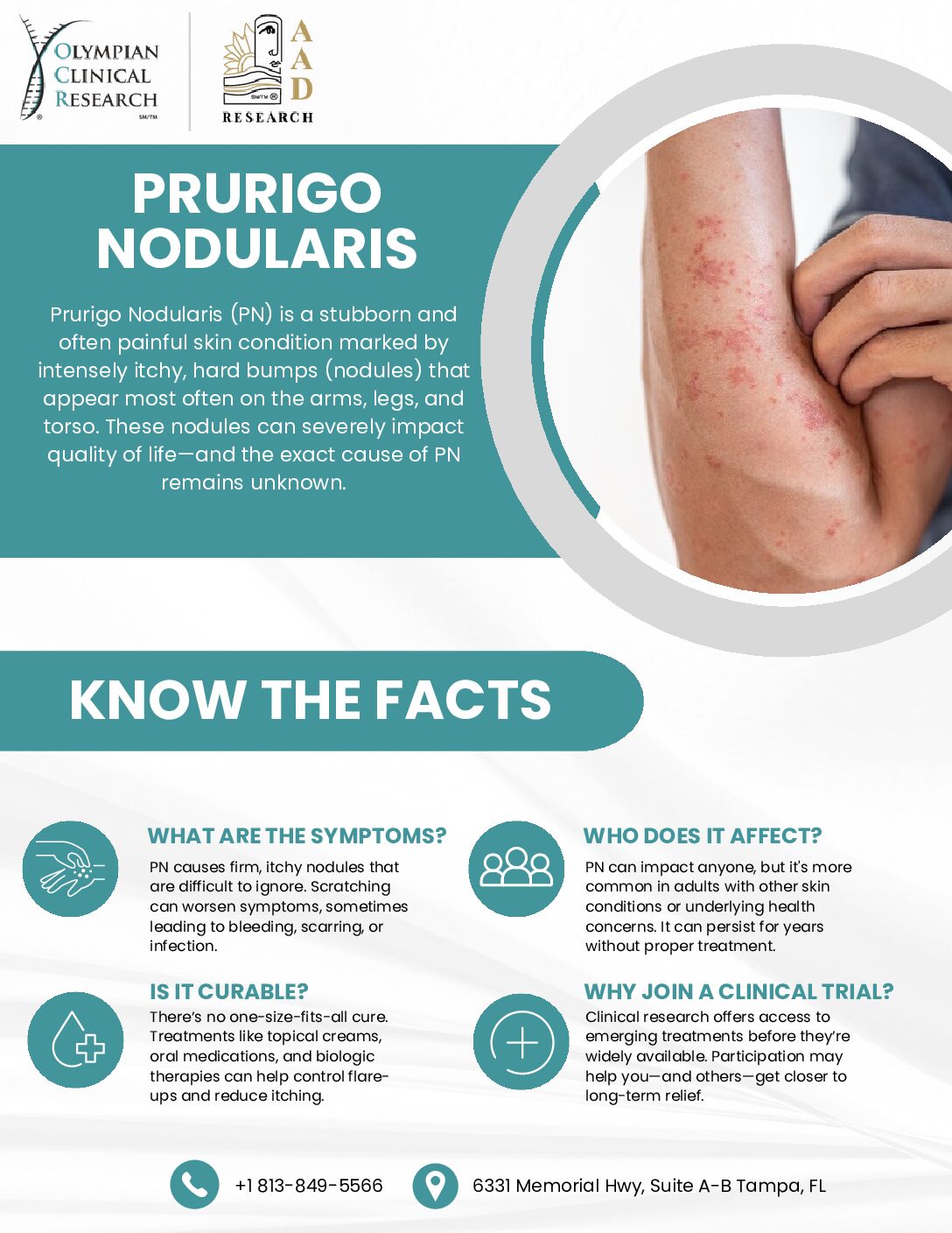 Prurigo nodularis (PN)